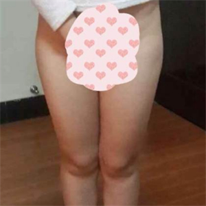 看看我大腿吸脂的恢復(fù)果圖片吧，是東方和諧王自謙做的