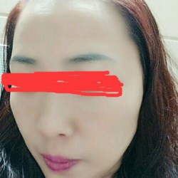 北京邦定張亞昆做的面部提升，果較為不錯(cuò)~