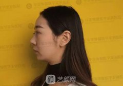 華美紫馨整形醫(yī)院隆鼻修復案例恢復全過程|內附圖哦