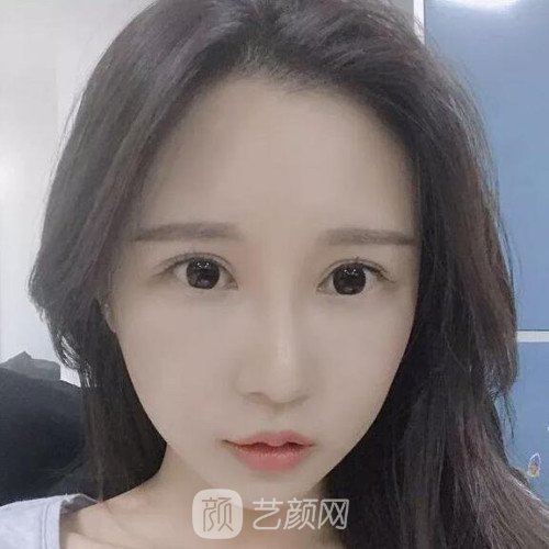 成都銅雀臺(tái)雷剛雙眼皮修復(fù)案例分享，半個(gè)月果圖~