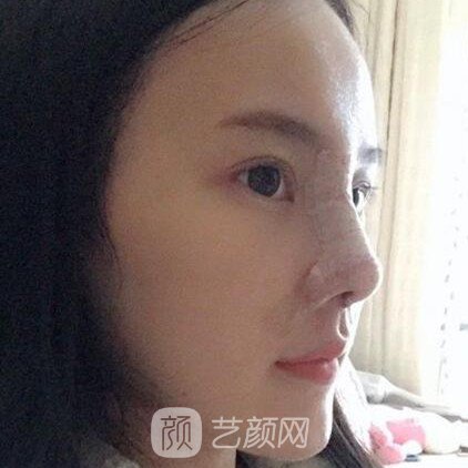 重慶聯(lián)合麗格王巖玻尿酸隆鼻三個(gè)月了，分享果照片~